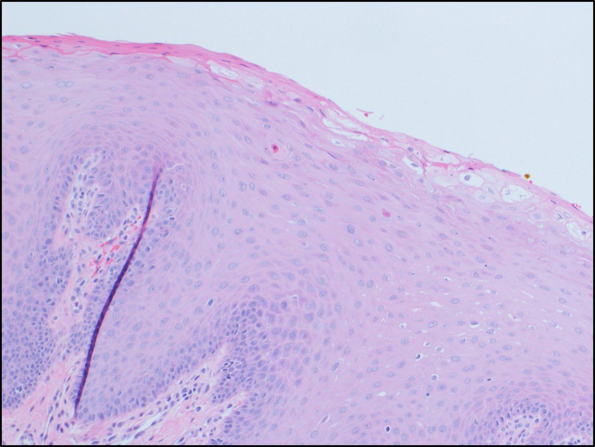 HajaratTara's tweet photo. Heck's Disease (Focal Epithelial Hyperplasia) shows irregular hyperplasia with hyperkeratosis, parakeratosis, and acanthosis with endophytic growth and widened and fused rete ridges. Mitosoid cells (arrows) are characteristic feature. It's due to HPV 13 &amp; 32 #pathology #dermpath https://t.co/7nLg9fOchk