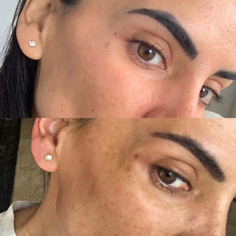 musely face rx for melasma