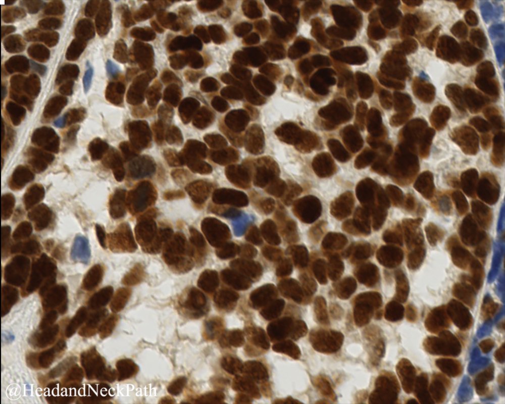 HPV-Related Multiphenotypic Sinonasal Carcinoma: Four Cases that Expand the Morpho-Molecular Spectrum and Include Occupational Data
rdcu.be/bSMae
#HeadNeckPathol #HNPJ #HeadandNeckPath #Pathology #ENTPath #PathologyTweet