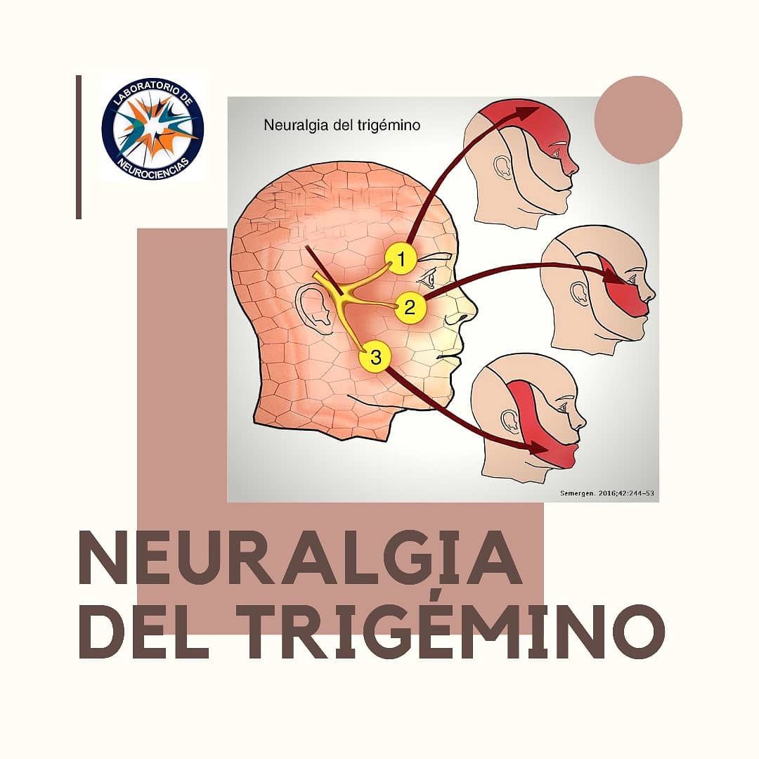 CentroCMN's tweet image. El #CasoClinico de esta semana es #NeuralgiaDelTrigemino