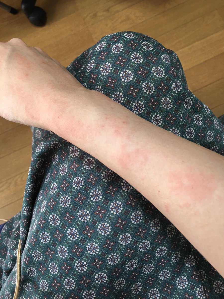 さと 受診してきましたー やっぱりステロイドだと根本的には治らない湿疹のようで 体調不良から来てるものだろうとのことなので しばらくはもっとゆっくりして行きたいと思います さと 受診してきましたー やっぱりステロイドだと根本的には治らない湿疹のようで 体調不良から来てるものだろうとのことなので しばらくはもっとゆっくりして行きたいと思います