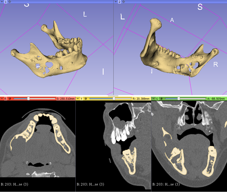 3d_maranon's tweet photo. 3D model of a mandible with a lithic lesion caused by a cyst. This structure will serve as the template from which the titanium prosthesis will be bent before surgery. 

Work by the Marañón FabLab Team: @rupermac @calvoharo_ja @diegotrap @luciagds @LauraFloresBM https://t.co/ZoJcwysroq