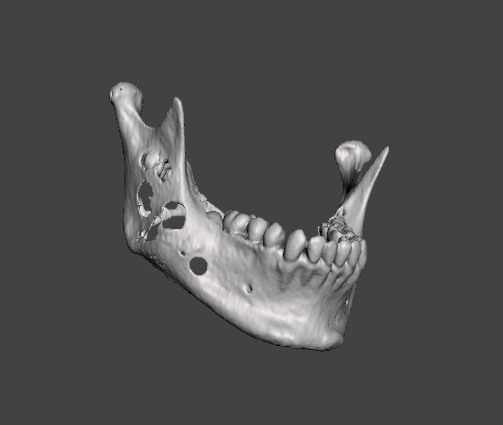 3d_maranon's tweet photo. 3D model of a mandible with a lithic lesion caused by a cyst. This structure will serve as the template from which the titanium prosthesis will be bent before surgery. 

Work by the Marañón FabLab Team: @rupermac @calvoharo_ja @diegotrap @luciagds @LauraFloresBM https://t.co/ZoJcwysroq