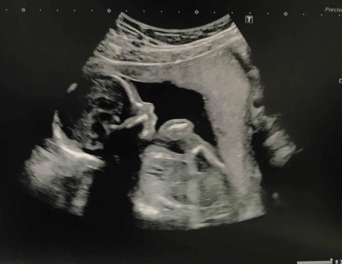 STO81E's tweet image. “I Am Your Father”

#20weekscan #ultrasound #royalinfirmaryedinburgh #pregnant #hyperemesis #cute #baby #mynose