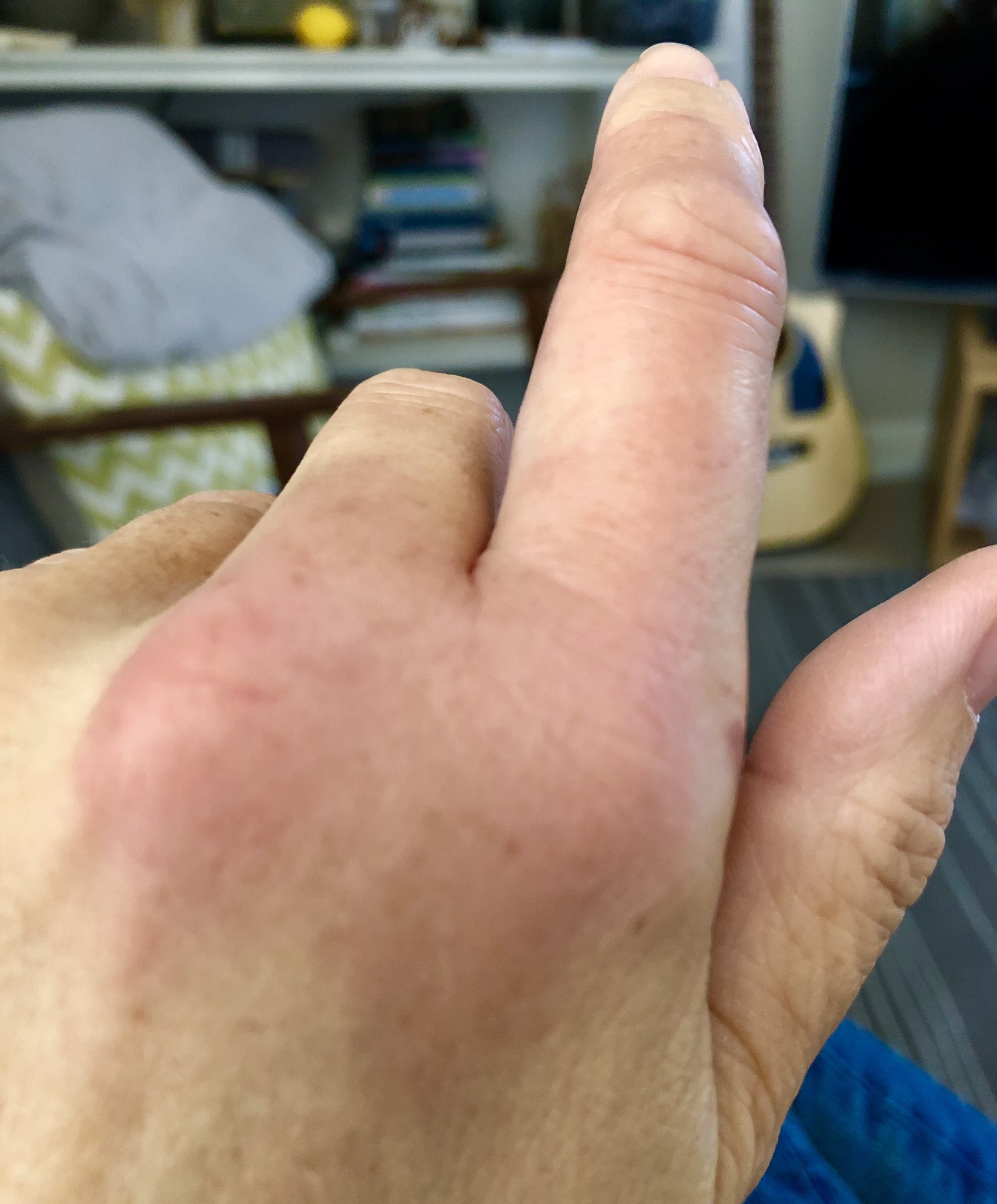 Claudia de Yong on X: "Allergy alert again ! Wasp stung me yesterday on the  inside of my finger and it traveled to the back of my hand in seconds  swelling up -