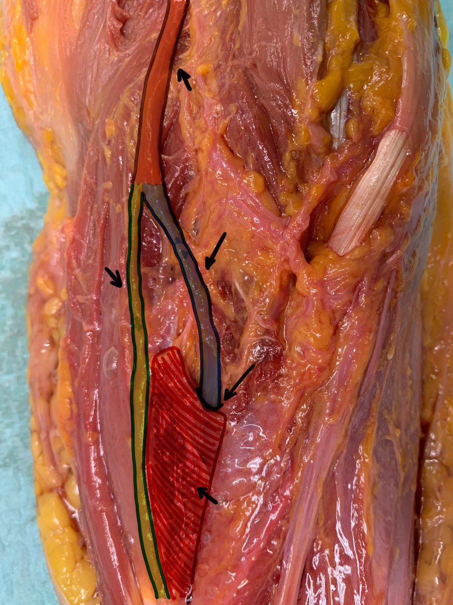 DrBarreraochoa's tweet photo. Anatomía Nervio Radial 
———-
▪️Ramo terminal del Fascículo Posterior del Plexo Braquial
▪️En el canal bicipital lateral donde se divide en 2️⃣ ramas
▪️1️⃣ Sensitiva: Profunda al trayecto del m. braquiorradial
▪️2️⃣ Motora (NIP): Atraviesa el músculo supinador por la Arcada de Fröshe https://t.co/PAIxUXgbl7