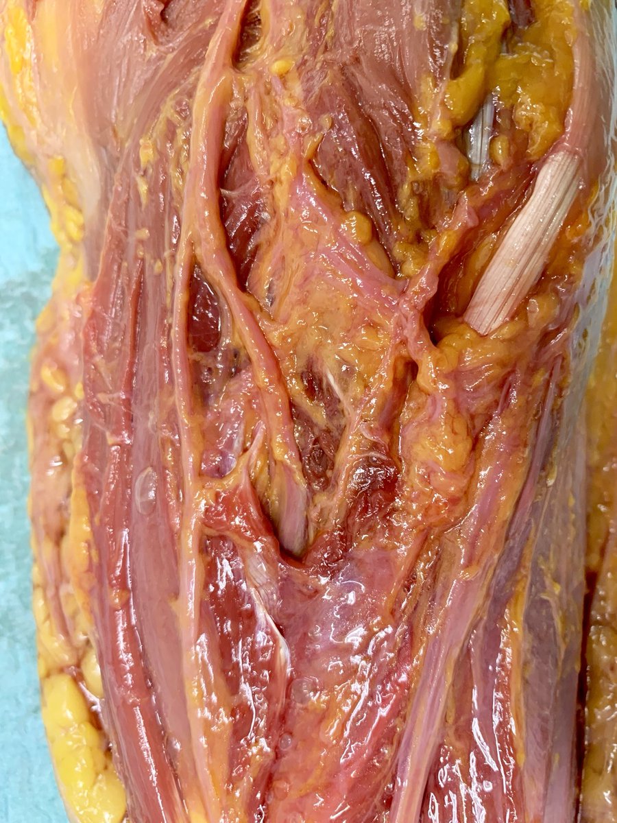 DrBarreraochoa's tweet photo. Anatomía Nervio Radial 
———-
▪️Ramo terminal del Fascículo Posterior del Plexo Braquial
▪️En el canal bicipital lateral donde se divide en 2️⃣ ramas
▪️1️⃣ Sensitiva: Profunda al trayecto del m. braquiorradial
▪️2️⃣ Motora (NIP): Atraviesa el músculo supinador por la Arcada de Fröshe https://t.co/PAIxUXgbl7