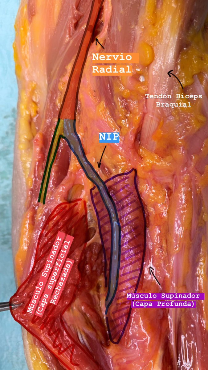 DrBarreraochoa's tweet photo. Anatomía Nervio Radial 
———-
▪️Ramo terminal del Fascículo Posterior del Plexo Braquial
▪️En el canal bicipital lateral donde se divide en 2️⃣ ramas
▪️1️⃣ Sensitiva: Profunda al trayecto del m. braquiorradial
▪️2️⃣ Motora (NIP): Atraviesa el músculo supinador por la Arcada de Fröshe https://t.co/PAIxUXgbl7