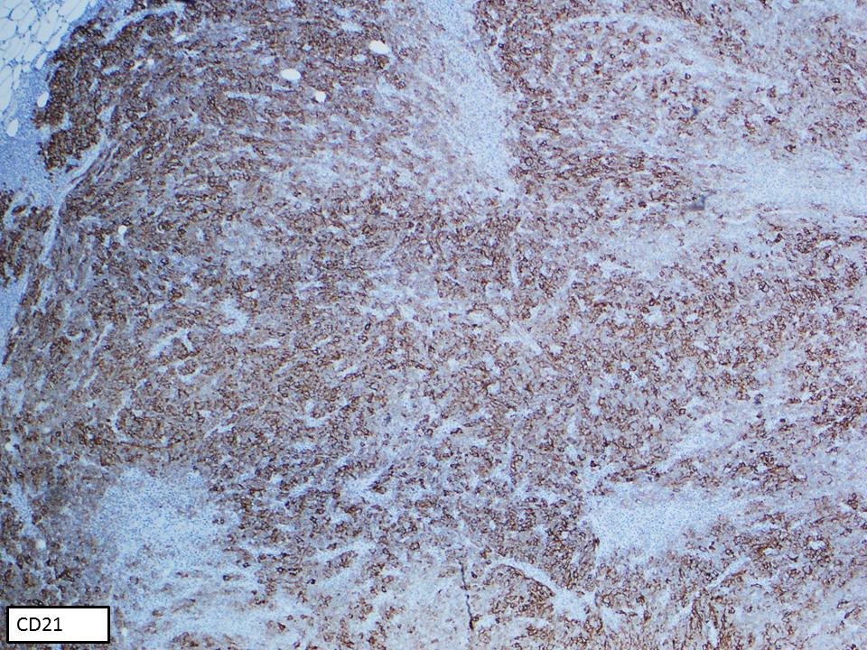 Follicular Dendritic Cell Sarcoma (FDCS) of the Breast: It can be misinterpreted as a triple negative breast carcinoma.The neoplastic cells are arranged in a storiform pattern, reminiscent of the architecture in meningiomas #Hemepath #LJMFridayUnknowns #HemepathMDA #endcancer