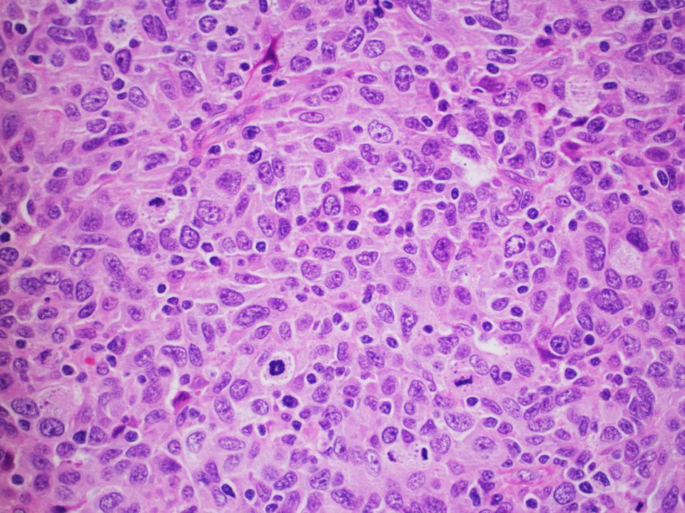 SibaElHussein's tweet photo. Follicular Dendritic Cell Sarcoma (FDCS) of the Breast: It can be misinterpreted as a triple negative breast carcinoma.The neoplastic cells are arranged in a storiform pattern, reminiscent of the architecture in meningiomas #Hemepath #LJMFridayUnknowns #HemepathMDA #endcancer https://t.co/Z2WvmAiYBi