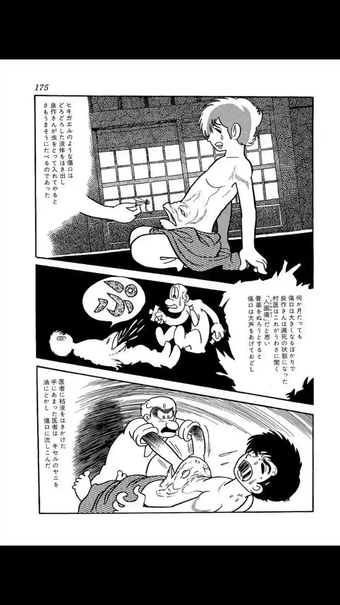 人面瘤
