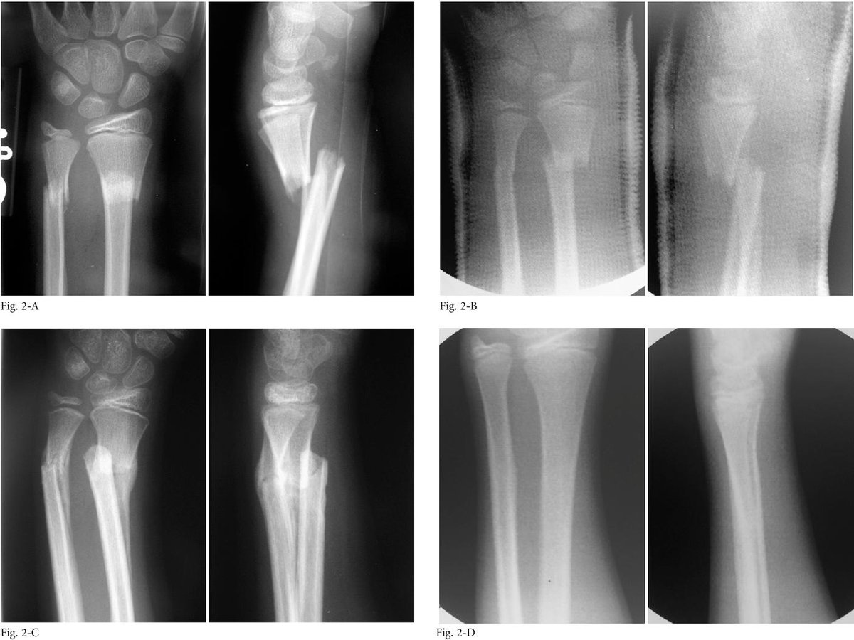 Damian_Roland's tweet image. The “Hawaii Paper”

Closed treatment of overriding distal radial fractures without reduction in children
ncbi.nlm.nih.gov/pubmed/22298057

Thought provoking…