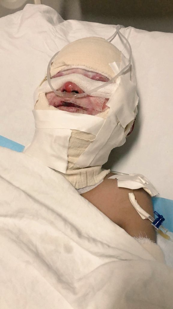 Please pray for Balaj, my 11 y/o Nephew suffering from severe burns, especially on the face after a gas leak explosion in his house in Pakistan last week.

His recovery is very slow and very painful so I humbly request that you please continue praying for him. ❤🙏🏽😔😭

Thank you