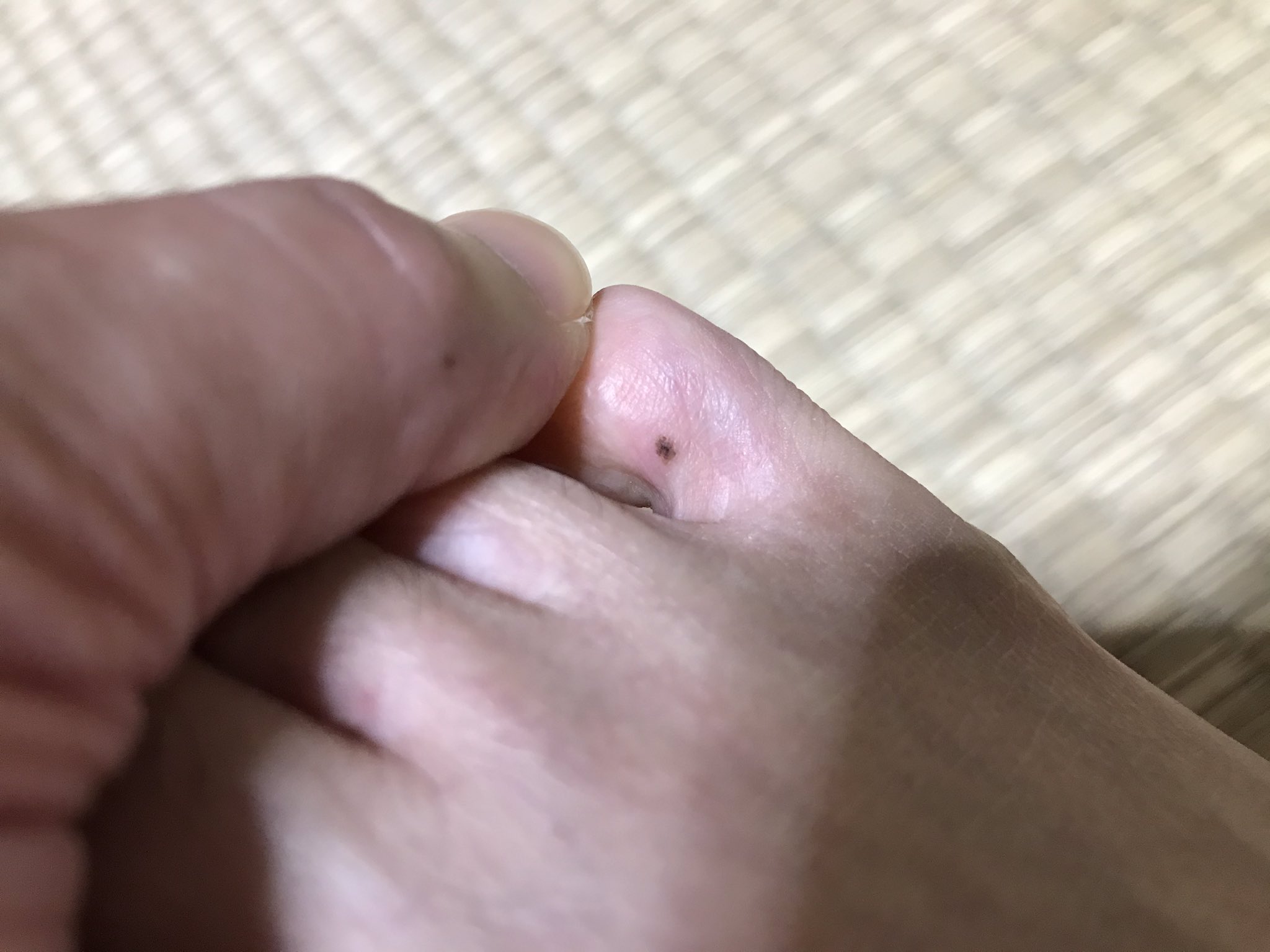 だいちゃん 今日気づいた ヤバいところにほくろできたし 木曜日 仕事帰りに診てもらいに行こ ほくろ メラノーマ 足の指 T Co Tuhfo3llxw Twitter
