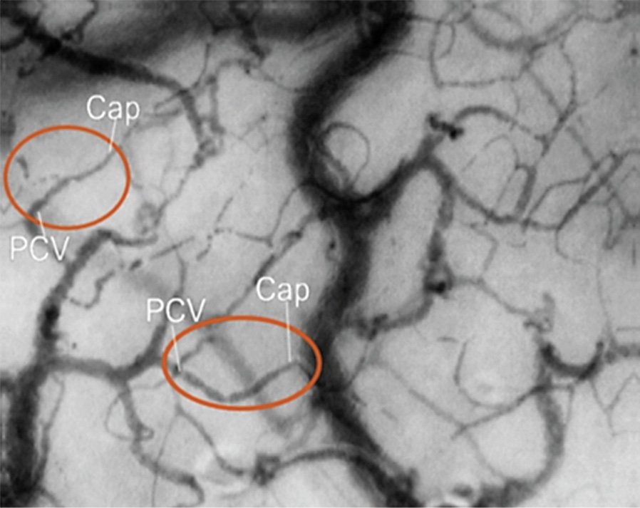 #Leukocyte-Endothelium Interaction in the Sublingual #Microcirculation of Coronary Artery Bypass Grafting Patients
👩‍⚕️Zühre Uz <a href="/amsterdamumc/">Amsterdam UMC</a> <a href="/ErasmusMC/">Erasmus MC</a> <a href="/BIDMCEM/">BIDMC Emergency Med</a> <a href="/acibademuniv/">Acıbadem Üniversitesi</a>
📰karger.com/Article/FullTe…