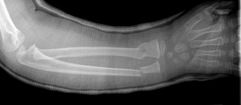 ALWAYS HERE TO HELP KIDS: Injured Children Will Always Remain Priority For Me. Mom Drove 2 Hours For Me To Fix Her Child's Arm . . Though Broken For 3 Weeks Now, The End Result Looks Promising

Primum Non Nocere,
#DoctorDan