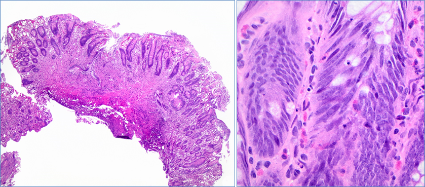 CArnoldMD's tweet photo. Is this cauterized ampulla or an adenoma? Join the @USGIPS session at #CAP2019 for Dr. Wei Chen's tips and tricks to this high-stake site. Details below.
@Pathologists #GIPATH #TwitterTeaser https://t.co/6skNV4twRb