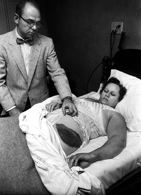 58- Anne Elisabeth Hodge, ici sur la photo. C'était le 30 novembre 1954 : la météorite est tombée sur sa maison alors qu'elle était allongée sur son canapé. Heureusement, elle n'a pas eu de blessures graves et s'en est sortie avec ces quelques séquelles.