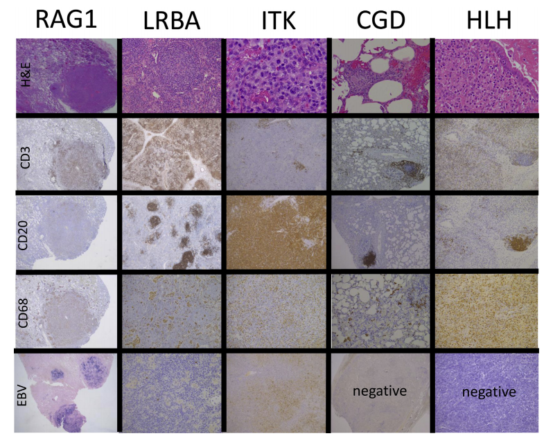 JACIInPractice's tweet image. In Current Issue! Life-threatening #pulmonary #interstitial #lung #disease complicating #pediatric #nonhumoral #immunodeficiencies buff.ly/2G1JMma