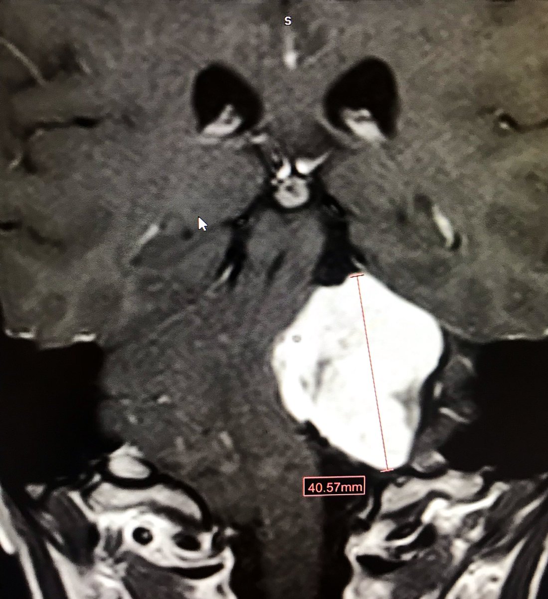 Young patient. 25 yo. Dizziness. #MRI #Neurosurgery
Diagnosis?
Treatment?