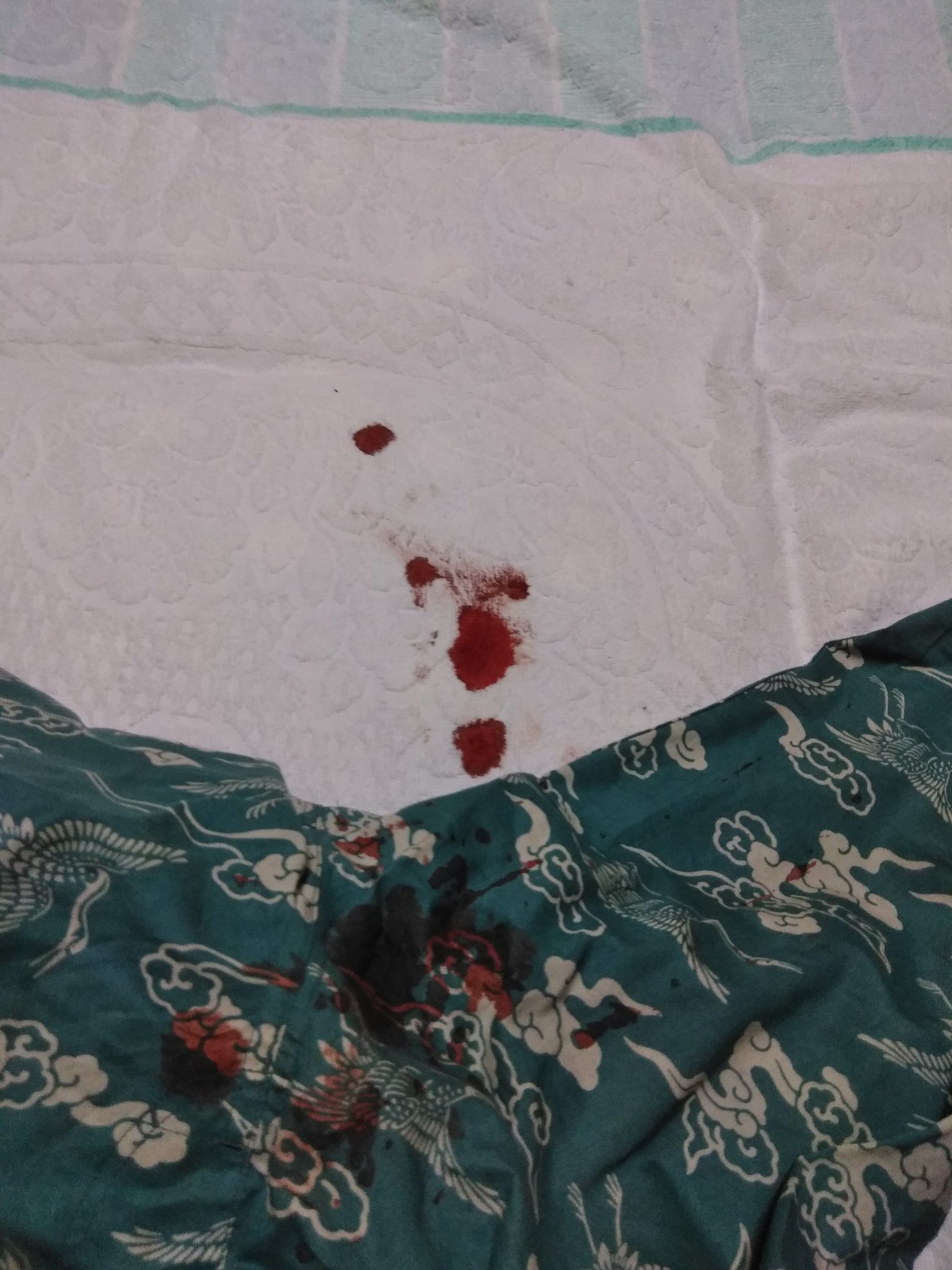 ネコしき 良性腫瘍 のもので特に大きな問題はないみたいなんだけど 30歳以降の男性に発生し 老人性血管腫の一種という説がある ってなんやねん 起きたら血だらけでマジびっくらこいてソッコーでググったよ 陰嚢被角血管腫