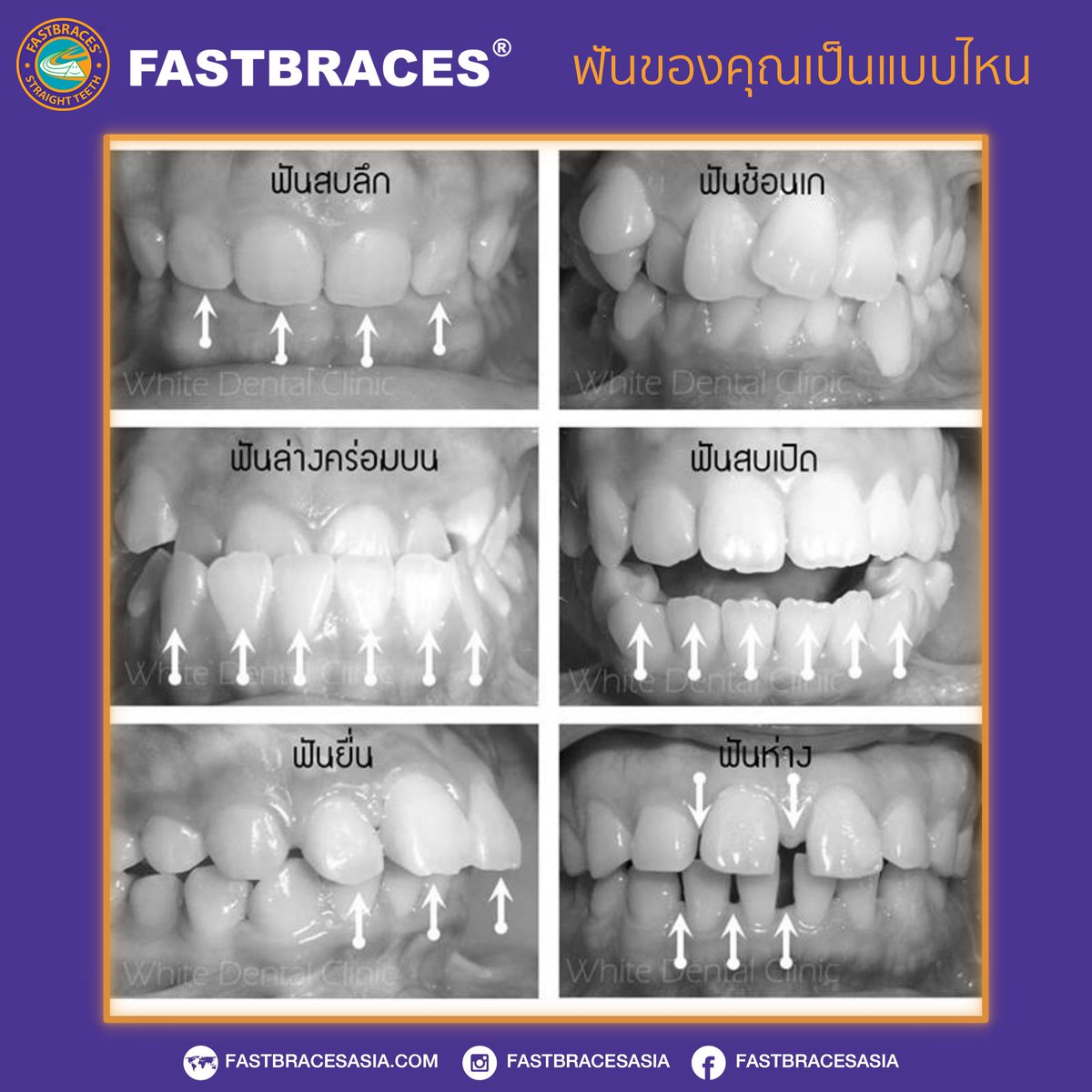 FastbracesAsia's tweet photo. จัดฟันไปทำไม แล้วแก้ปัญหาฟันแบบไหนได้บ้าง?
เราจำเป็นต้องจัดฟันมั้ย?
ไปดูกันดีกว่าฟันของเราเป็นแบบไหน
ต้องรีบปรึกษาคุณหมอดีมั้ย?
ถามใครไม่ได้ คุยกับแอดมินฟาสเบรสก่อนค่ะ
#แบร็กเก็ตสามเหลี่ยม #จัดฟัน
#จัดฟันเร็ว #เจ็บน้อย #เหงือกไม่ร่น
#ไม่ถอนฟัน #ฟาสเบรส #fastbraces https://t.co/kE1lMQcuSB