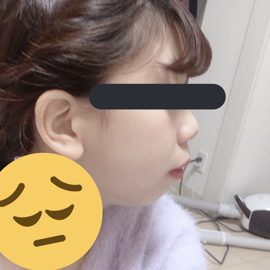 な 顎変形症 手術前と手術後18日目です 手術前の写真は何年か前になりますが 横顔がすごく変わりました これから入院中のことや経過など呟きたいと思うので同じ手術をされた方や同じ手術される方へ情報を交換 提供できたらと思っています な 顎変形症 手術前と手術後18日目です 手術前の写真は何年か前になりますが 横顔がすごく変わりました これから入院中のことや経過など呟きたいと思うので同じ手術をされた方や同じ手術される方へ情報を交換 提供できたらと思っています