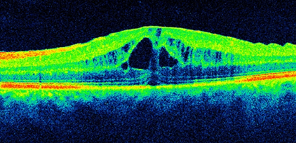 Eye_Institute's tweet photo. Our own Dr Lewis Levitz and other leading experts have argued that NSAIDs shouldn't be viewed as a go-to treatment for pseudophakic cystoid macular oedema. Read their letter at https://t.co/J6K5uGTqZ2
#visioneyeinstitute #cataractsurgery #cataracts #PCMO https://t.co/mpr2xx8sDs
