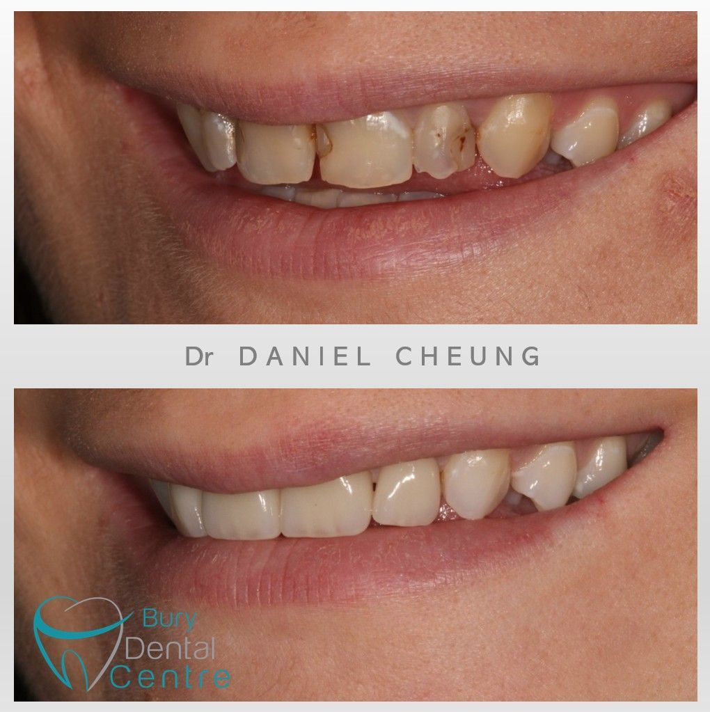 😁
#Bury #Dental #Buryhour #smile
instagram.com/burydental