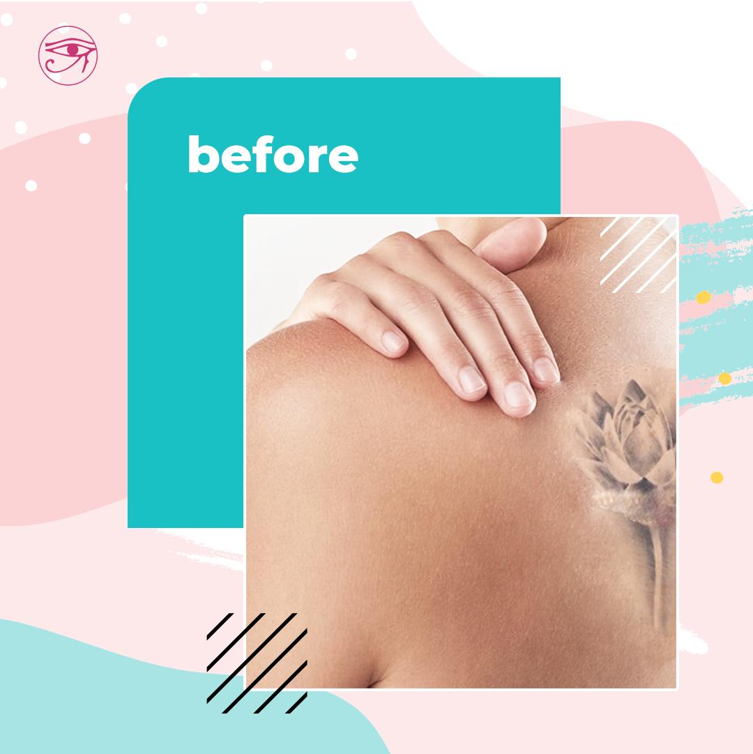 miracles_clinic's tweet photo. Revitalize your skin with our #Picosure treatment, a revolutionary technology which has no downtime.
To book an appointment, visit https://t.co/gnEDz6AapF

#miraclesaestheticclinic #picosuretattooremoval #skinrevitalization #FDAapproved https://t.co/SmbmvLXt8j