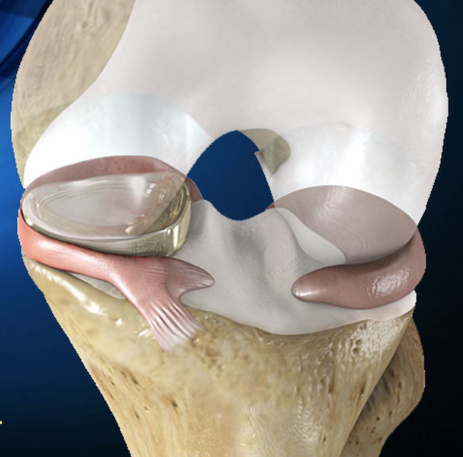 First polymer-based meniscus implant granted expedited review by #FDA ow.ly/Rdoj50wmbXS @Active_Implants