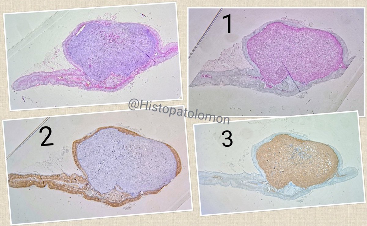 Histopatolomon's tweet photo. I present an H&E and three #IHCpath. Could you tell me which is 1, 2 and 3?
#macromicropath #macromicrocorrelation #grossmicropath #grossmicrocorrelation
#histopatolomon https://t.co/qDiyQazRPO