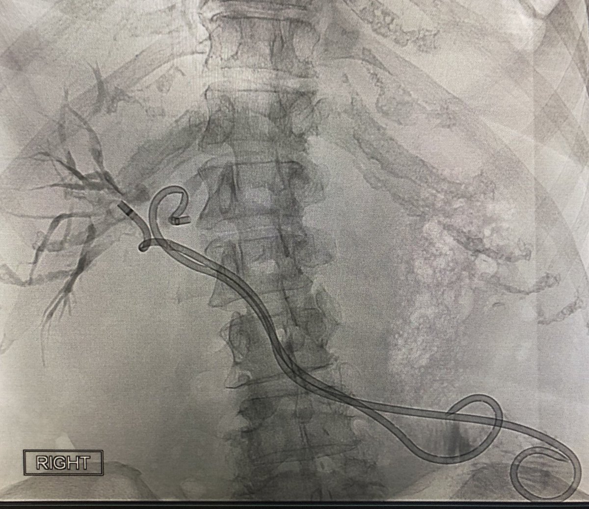 saherssabri's tweet photo. Perc placed Internal biliary stents. A new option with easy conversion from internal-external drain #ConvertX @MeritMedical https://t.co/HUXMBsJKoi