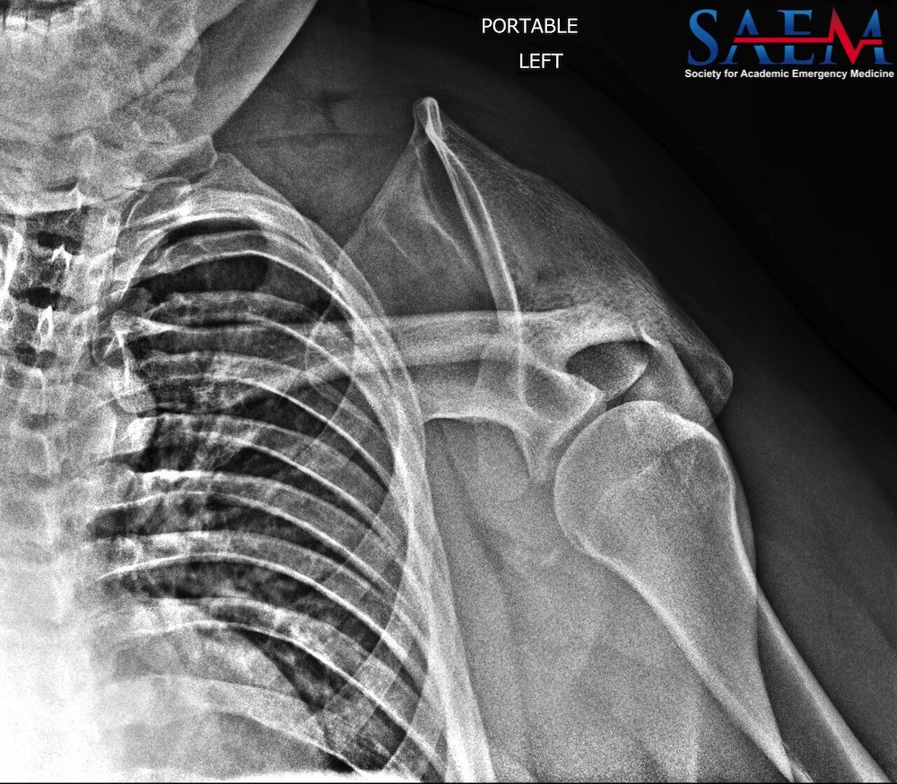 ALiEMteam's tweet photo. SAEM Clinical Images Series | A patient presents with traumatic 💥 shoulder pain and these images. What is the diagnosis, and what complications may arise? By Drs. Murray, Gibbs, and Wares.

https://t.co/IL2ojnKj1Y https://t.co/1fqrpADvSe