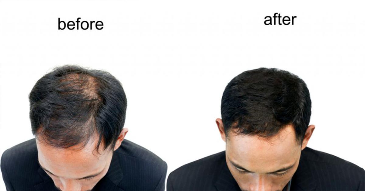 RoboHairDoc's tweet photo. Take a look at this impressive before and after shot! https://t.co/0KFgg9GDj6