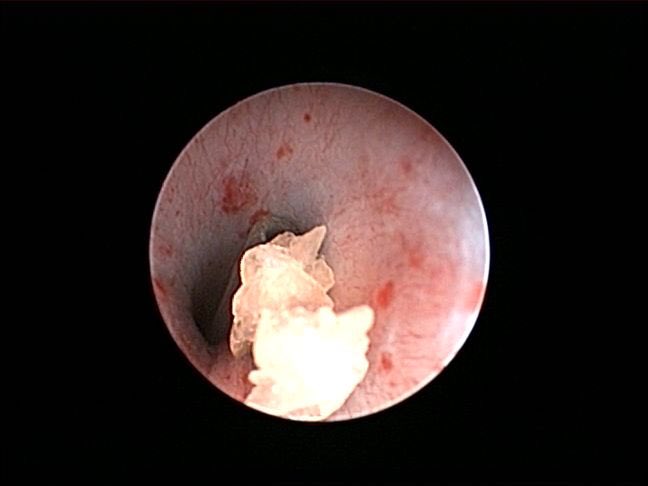 delangelvet's tweet photo. Urolitiasis de oxalato de calcio en gatos. En México, este es el tipo de urolitos mas frecuente, presentándose principalmente en los machos mayores de 6 años. // Feline Calcium oxalete urolithiasis.
#NUVetMex #delangelvet #hvpeuaemex #veterinaryhospital #hospitalveterinario https://t.co/YkErbQnI3P