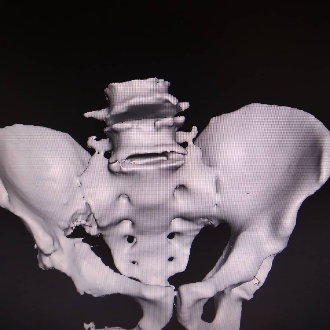 MM3D_'s tweet photo. STL model ready to print!! π
#3dmodel #3dprinting #impresion3d #medicalmodel3d #custom3dmodel
#bones #traumatologia #pelvis #mm3d_ https://t.co/y8xw9xXY2t