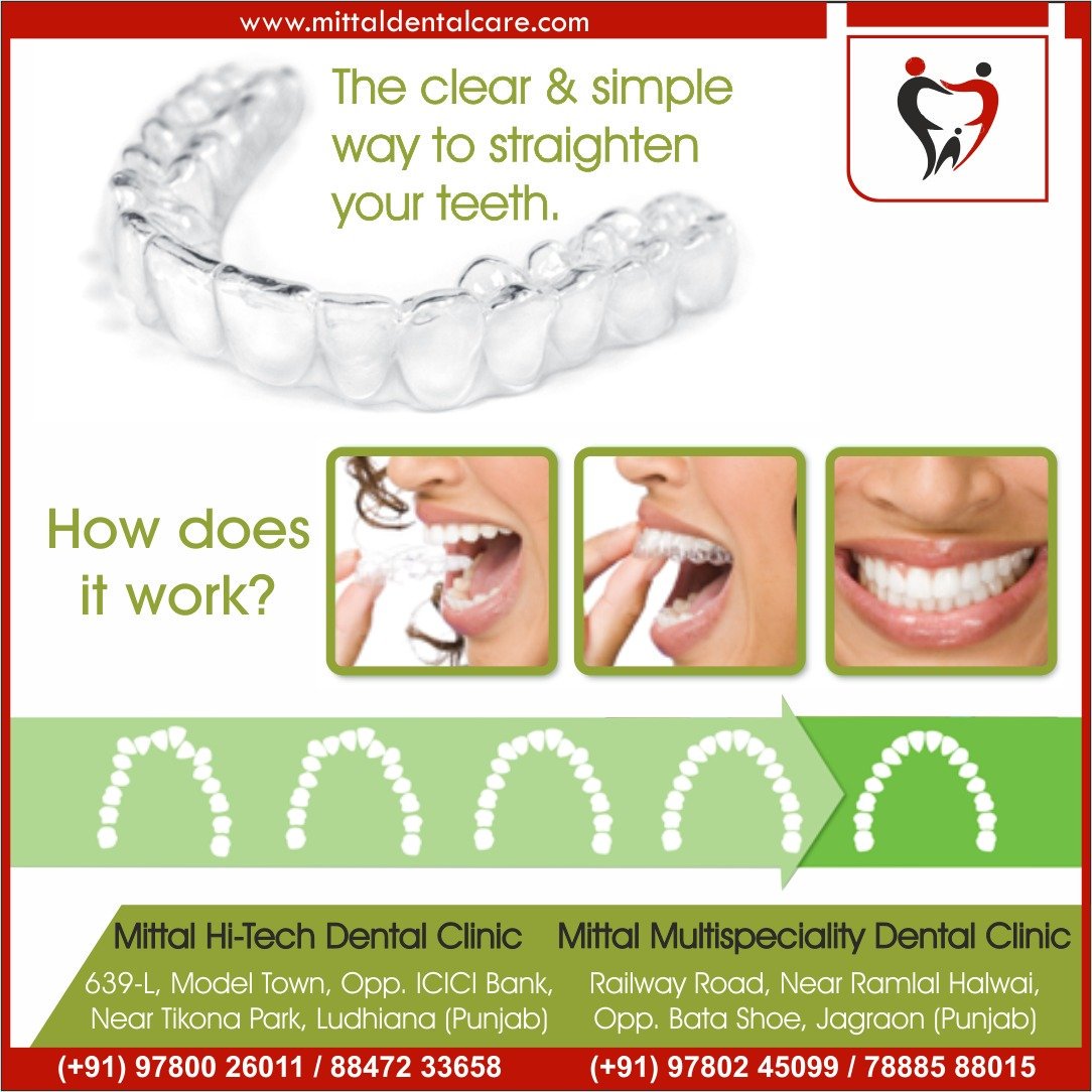 Mittaldentalclinic On Twitter Smile Is A Curve That Sets Everything Straight Mittaldentalcare Mittaldentalcarejagraon Orthodontist Pedodontist Dentist Rct Teethstraightening Invisalign Tooth Teeth Implant Singlesitting Smile