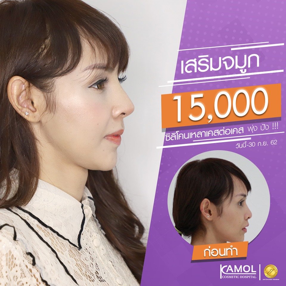 KamolHospitalTH's tweet photo. 🛡 เสริมจมูกพุ่งปัง 15,000 บาท 🛡
โปรโมชั่นวันนี้ - 30 ก.ย. 62

จองสิทธิ์โปรโมชั่น+สอบถามเพิ่มเติม

👉Tel : 02-559-0151
👉FB :โรงพยาบาลกมลศัลยกรรมตกแต่งและแปลงเพศ
👉Line:@Kamolhospital
👉IG:Kamol_Hopital

#จมูก #เสริมจมูก #ทำจมูก #แก้จมูก 
#เสริมจมูกผู้ชาย #เสริมจมูกทอม https://t.co/FM01SCpa4K