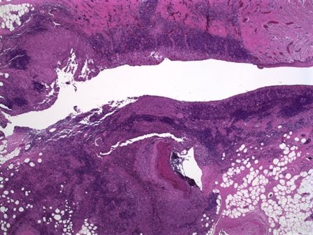 patologiaead's tweet photo. #Ulcerated #vulvar lesion. The surface of vulvar specimen demonstrates #ChronicInflammation with ulceration, and several nodular lesions in superficial and deep dermis are identified with infiltration of langerhans cells.
https://t.co/TtlY1glQGw
#PatoInfoBioMed
@UFCSPA_patho https://t.co/9WWcOBIMC6