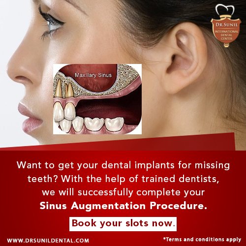 drsunilphol's tweet image. #SinusAugmentation #SinusLift #SinusProblem #SinusTreatment #DentalTreatment #BangkokDentist #BangkokDiscoverYourSmile #ThailandDental
Visit: drsunildental.com

Call us on: + (66)-81648-5780 or + (66)-2314-6238
WhatsApp No: +66816485780
Email: info@drsunildental.com