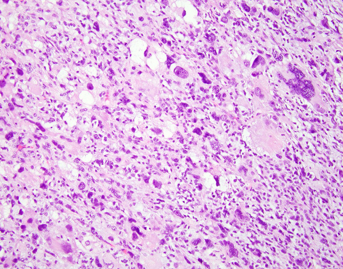 LizMontgomeryMD's tweet photo. Love sarcomas that require no stains. A nice pleomorphic liposarcoma from the recent catch. These things have WEIRD nuclei! https://t.co/h80ey2K3lt