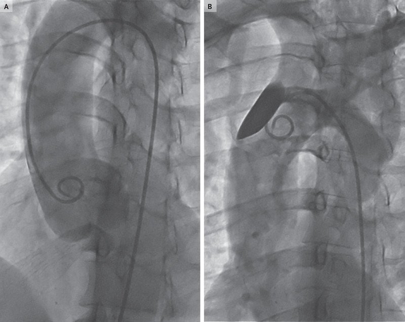 NEJM's tweet photo. From the #NEJMArchive: Aortic Dissection during Diagnostic Aortography https://t.co/YRXqUVRl9i https://t.co/lgF93s3Udd