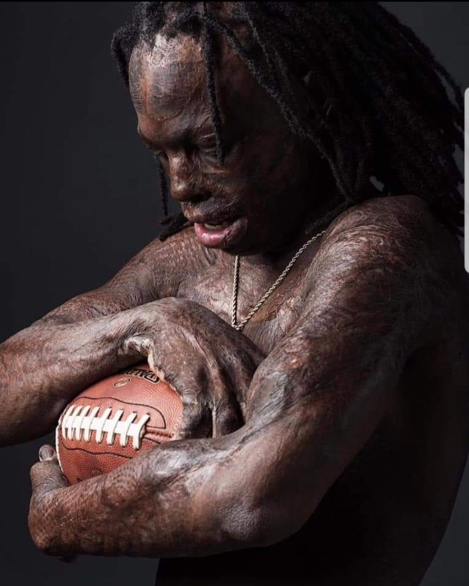 #TaquariusWair, (TQ) high school football player, is in his senior year. Burned 55% of his body some places to the bone at age 4. His mother pulled him from the fire, but he ran back in trying to save his oldest sister. She didn't survive.
You have no idea who you can inspire!