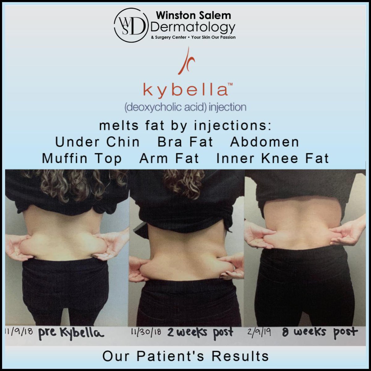 wsdermdivas's tweet photo. Dr. Chris targets difficult areas for reduction while melting fat with Kybella. The banana roll and muffin top.

#winstonsalem #dermatology #cosmetics #kybella #fatloss https://t.co/pueMvZrBSP