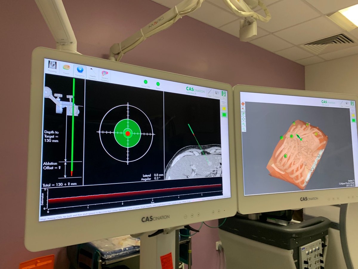TzeWah1's tweet photo. The Leeds #irad team had a good training session on using #navigation system to target tumour #CAScination #IO
Dr Jon Smith’s top comment #whatapieceofGreatEngineering
@TraineesBSIR @BSIR_News @UK_NIRS @samjeans @ThijsStoker https://t.co/Hp1SAupbcG