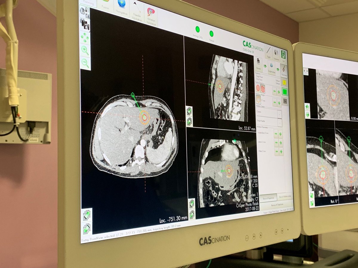 TzeWah1's tweet photo. The Leeds #irad team had a good training session on using #navigation system to target tumour #CAScination #IO
Dr Jon Smith’s top comment #whatapieceofGreatEngineering
@TraineesBSIR @BSIR_News @UK_NIRS @samjeans @ThijsStoker https://t.co/Hp1SAupbcG