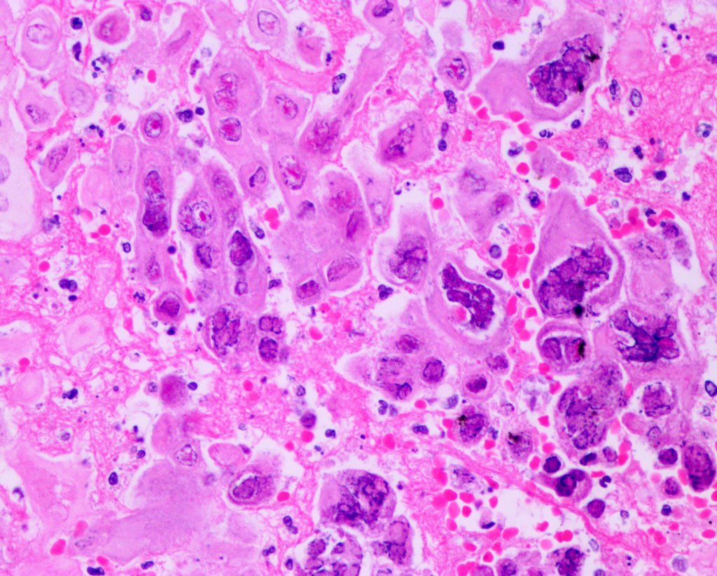 AdoniDuarte's tweet photo. Ulcers with necrotic debris with abundant epithelial cells with viral inclusions, multinucleated squamous cells, #CowdryTypeA and perinuclear clear halo; ground glass inclusions in a case of #HerpesSimplexEsophagitis in a patient diagnosticated with SLE. #GIPath #InfectiousPath https://t.co/HY5Vi310hW