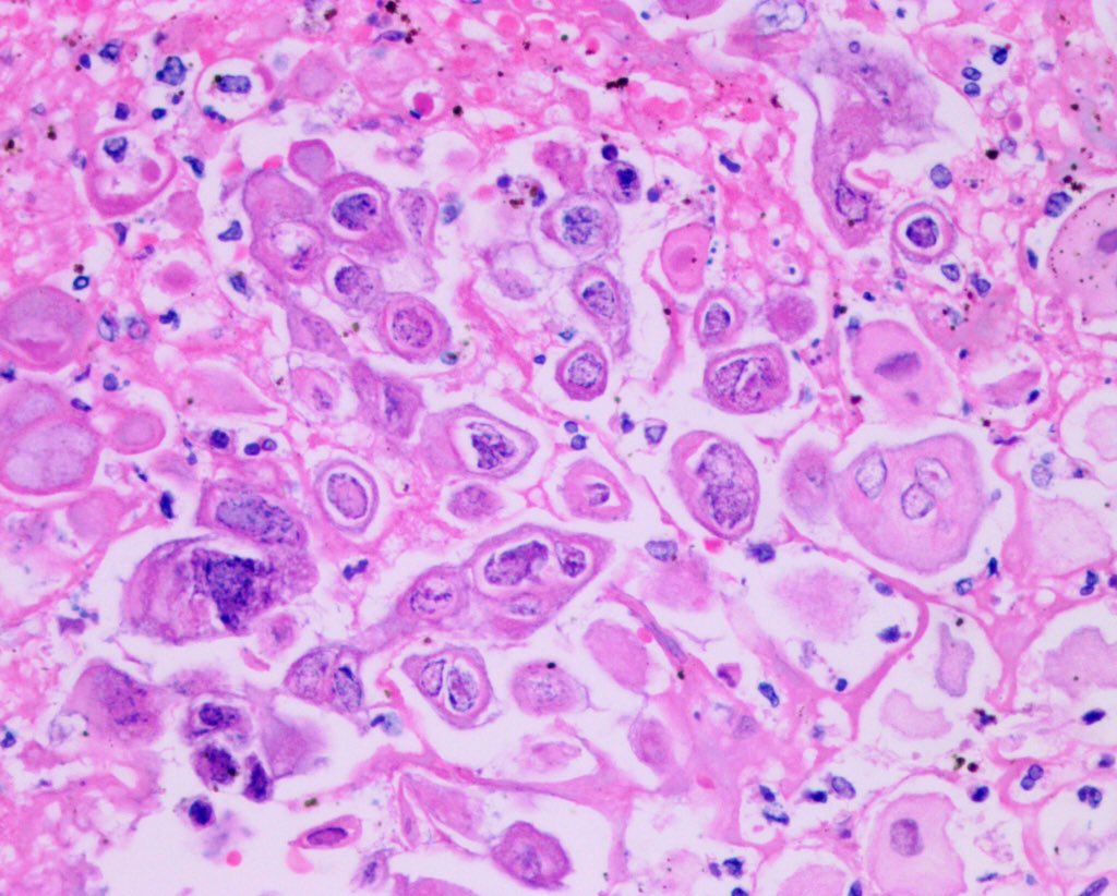 AdoniDuarte's tweet photo. Ulcers with necrotic debris with abundant epithelial cells with viral inclusions, multinucleated squamous cells, #CowdryTypeA and perinuclear clear halo; ground glass inclusions in a case of #HerpesSimplexEsophagitis in a patient diagnosticated with SLE. #GIPath #InfectiousPath https://t.co/HY5Vi310hW