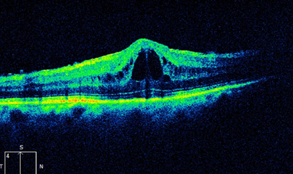 Eye_Institute's tweet photo. Our own Dr Lewis Levitz and other leading experts have argued that NSAIDs shouldn't be viewed as a go-to treatment for pseudophakic cystoid macular oedema. Read their letter at https://t.co/J6K5uGTqZ2
#visioneyeinstitute #cataractsurgery #cataracts #PCMO https://t.co/iIeUJ0xAFo